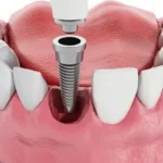 dental braces mascot